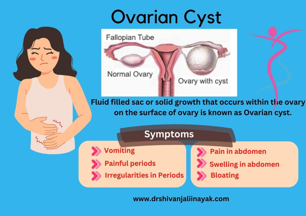 What is Ovarian Cyst and what are its symptoms by Dr Shivanjali Nayak, Gynecologist Kolkata