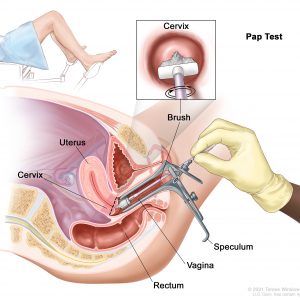 Cancer Screening Cervical Cancer