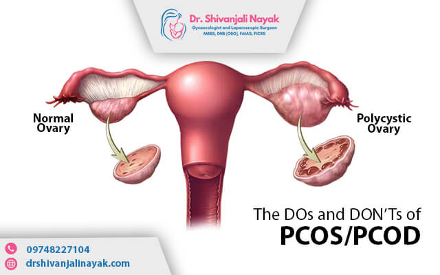 do's and don'ts to manage PCOS