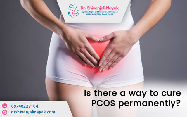 Is there a way to cure PCOS permanently