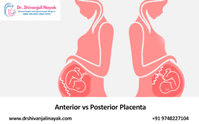 Anterior vs Posterior Placenta