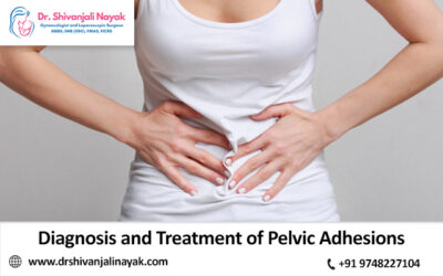 Diagnosis and Treatment of Pelvic Adhesions