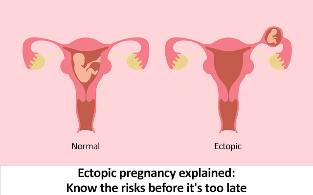 Ectopic pregnancy explained: Know the risks before it’s too late