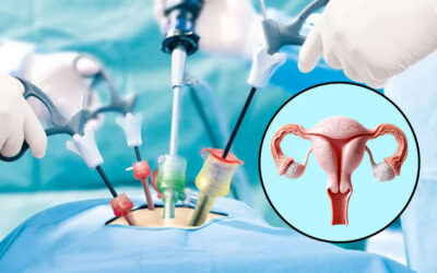 Laparoscopic Surgery for Ovarian Cysts: How It Works & Why It’s Preferred Nowadays
