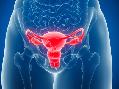 PCOS